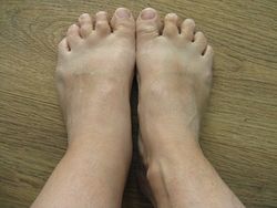 Swollen ankle after insect bite